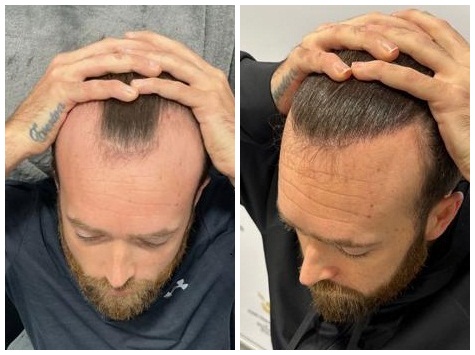 hair transplants