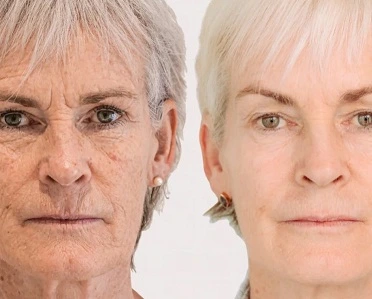 morpheus8 before and after