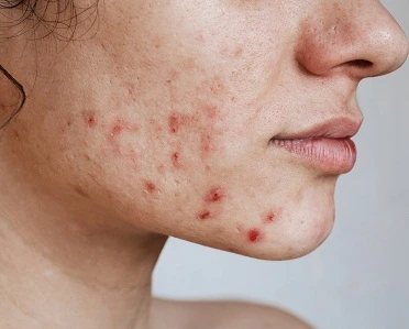 morpheus8 for acne scars
