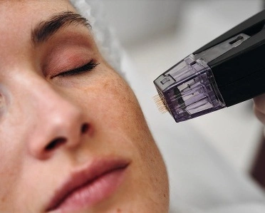 morpheus8 vs microneedling liverpool