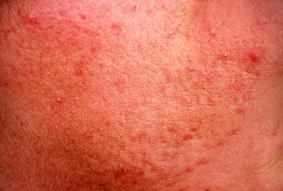rosacea liverpool