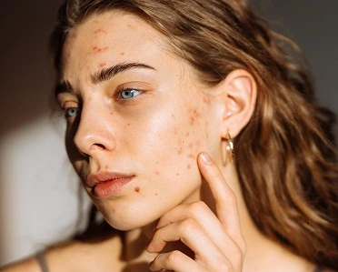 rosacea treatment liverpool patient