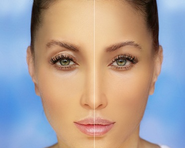hooded eye removal liverpool before and after upper blepharoplasty patient