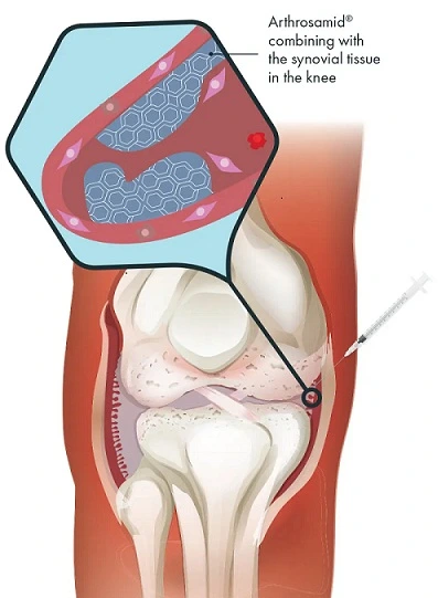 knee osteoarthritis treatment