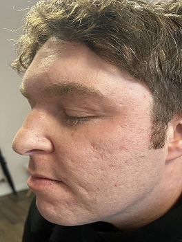 acne scarring before