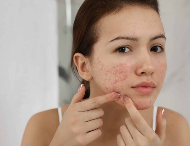 treatment for acne liverpool