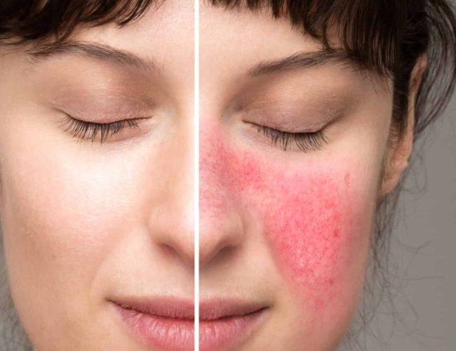ROSACEA TREATMENT LIVERPOOL